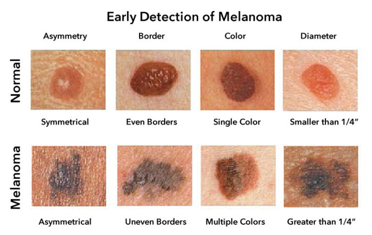 melanoma-skin-cancer